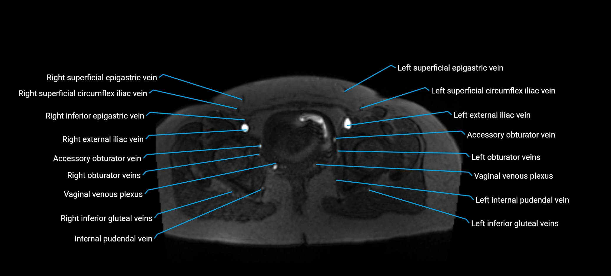 MRV abdomen pelvis & lower limb axial cross sectional anatomy labelled MRI image 181 (1).webp